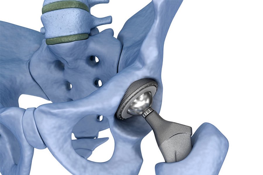 Silicone implants are used for hip replacement