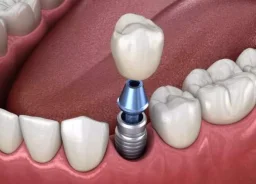 Silicone implants are used for dental implants